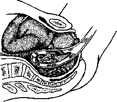Obstetric Forceps: figure 4 from the 1928–1936 encyclopedia article