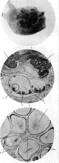 Odontoma: figure 2 from the 1928–1936 encyclopedia article