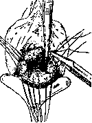Hysterectomy: figure 7 from the 1928–1936 encyclopedia article