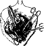 Hysterectomy: figure 6 from the 1928–1936 encyclopedia article