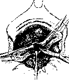 Hysterectomy: figure 5 from the 1928–1936 encyclopedia article