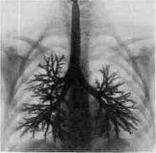 Bronchomycoses: figure 1 from the 1928–1936 encyclopedia article