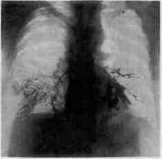 Bronchomycoses: figure 4 from the 1928–1936 encyclopedia article
