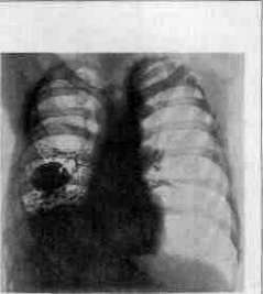 Bronchomycoses: figure 2 from the 1928–1936 encyclopedia article