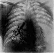 Bronchomycoses: figure 3 from the 1928–1936 encyclopedia article