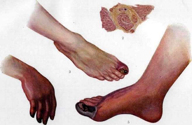 Gangrene: figure 1 from the 1928–1936 encyclopedia article