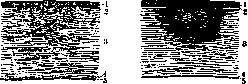Leukoma: figure 2 from the 1928–1936 encyclopedia article
