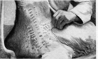 Smallpox Detritus: figure 4 from the 1928–1936 encyclopedia article