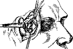 Kronlein Operation: figure 2 from the 1928–1936 encyclopedia article