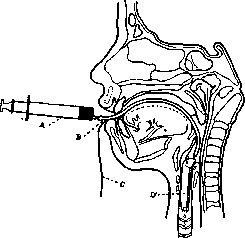 Bronchography: figure 1 from the 1928–1936 encyclopedia article