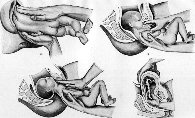 Obstetric Manual Maneuvers: figure 8 from the 1928–1936 encyclopedia article