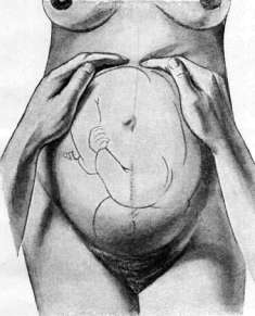 Obstetric Manual Maneuvers: figure 3 from the 1928–1936 encyclopedia article