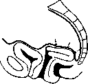 Uterine Prolapse: figure 6 from the 1928–1936 encyclopedia article