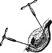 Pelveoperitonitis: figure 12 from the 1928–1936 encyclopedia article