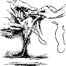 Pelveoperitonitis: figure 8 from the 1928–1936 encyclopedia article