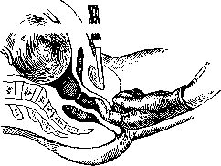 Pelveoperitonitis: figure 2 from the 1928–1936 encyclopedia article