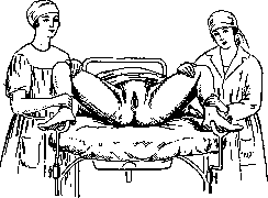 Pelveoperitonitis: figure 5 from the 1928–1936 encyclopedia article