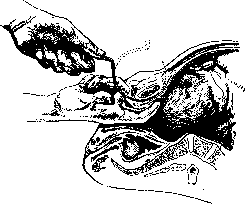 Pelveoperitonitis: figure 11 from the 1928–1936 encyclopedia article