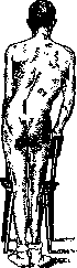 Sciatica: figure 2 from the 1928–1936 encyclopedia article