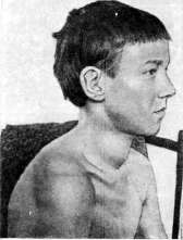 Goiter: figure 3 from the 1928–1936 encyclopedia article