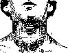 Goiter: figure 11 from the 1928–1936 encyclopedia article