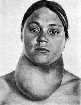 Goiter: figure 6 from the 1928–1936 encyclopedia article