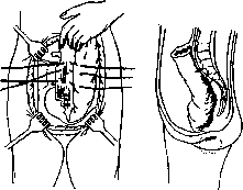 Rectal Prolapse: figure 9 from the 1928–1936 encyclopedia article