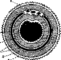 Rectal Prolapse: figure 4 from the 1928–1936 encyclopedia article