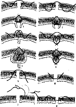 Intestinal Suture: figure 1 from the 1928–1936 encyclopedia article