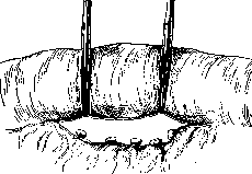 Intestinal Suture: figure 6 from the 1928–1936 encyclopedia article