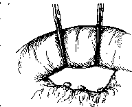 Intestinal Suture: figure 8 from the 1928–1936 encyclopedia article