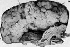 Nephropathy: figure 3 from the 1928–1936 encyclopedia article