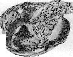Nephropathy: figure 1 from the 1928–1936 encyclopedia article
