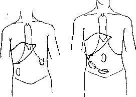 Splanchnoptosis: figure 5 from the 1928–1936 encyclopedia article