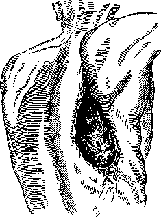Bronchial Fistulas: figure 3 from the 1928–1936 encyclopedia article