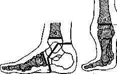 Vladimirov-Mikulicz Operation: figure 2 from the 1928–1936 encyclopedia article