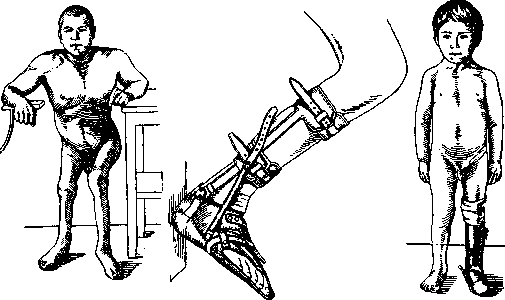 Childhood Paralysis: figure 12 from the 1928–1936 encyclopedia article