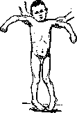 Childhood Paralysis: figure 2 from the 1928–1936 encyclopedia article