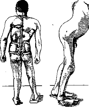 Childhood Paralysis: figure 11 from the 1928–1936 encyclopedia article