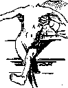 Childhood Paralysis: figure 1 from the 1928–1936 encyclopedia article