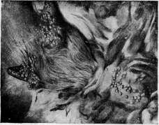 Smallpox (Variola): figure 13 from the 1928–1936 encyclopedia article