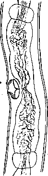 Trichostrongyloidosis: figure 2 from the 1928–1936 encyclopedia article