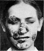Immunotherapy: figure 1 from the 1928–1936 encyclopedia article