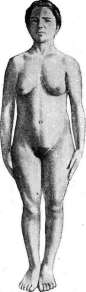 Dwarfism: figure 1 from the 1928–1936 encyclopedia article