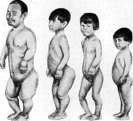 Dwarfism: figure 2 from the 1928–1936 encyclopedia article