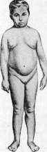 Dwarfism: figure 6 from the 1928–1936 encyclopedia article