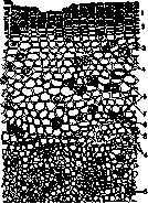Carcinosarcoma: figure 1 from the 1928–1936 encyclopedia article