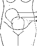 Postpartum Period: figure 3 from the 1928–1936 encyclopedia article
