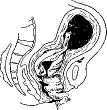 Postpartum Period: figure 15 from the 1928–1936 encyclopedia article
