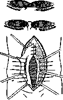 Hernias: figure 18 from the 1928–1936 encyclopedia article